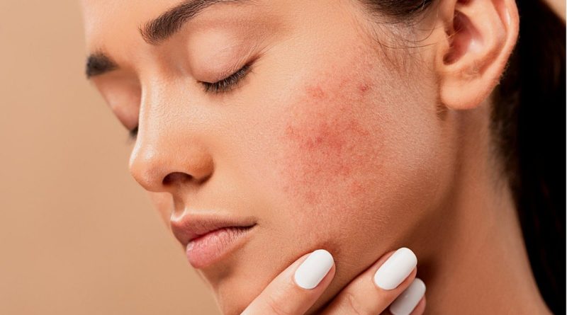 Acne Pimples Spots Zits Skin  - jmexclusives / Pixabay