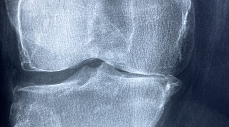 Knee X Rays Arthritis Skeleton  - Taokinesis / Pixabay