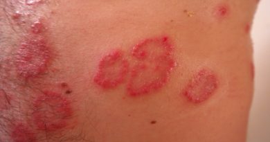 Rash Red Inflamed Reddish  - Hans / Pixabay