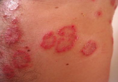 Trápí vás nebo vaše dítě atopický ekzém? Zkuste ho zmírnit zlepšením své stravy a vynecháním dráždivých potravin Rash Red Inflamed Reddish - Hans / Pixabay