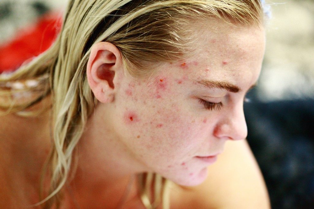 Struggle Acne Self Love Skin Face  - SharonMcCutcheon / Pixabay